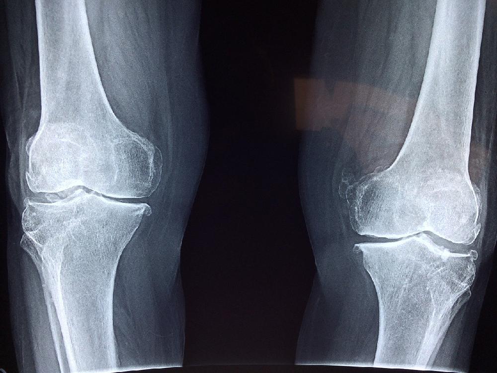 Co warto wiedzieć na temat artroskopii kolana?